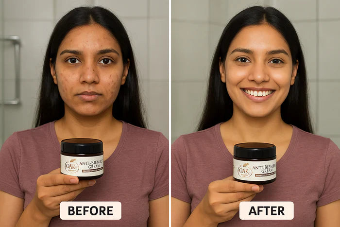 Anti-Blemishes Cream-Goodness of Sea Buckthorn Oil, Shea Butter, Aloe & Saffron | For All Skin Types