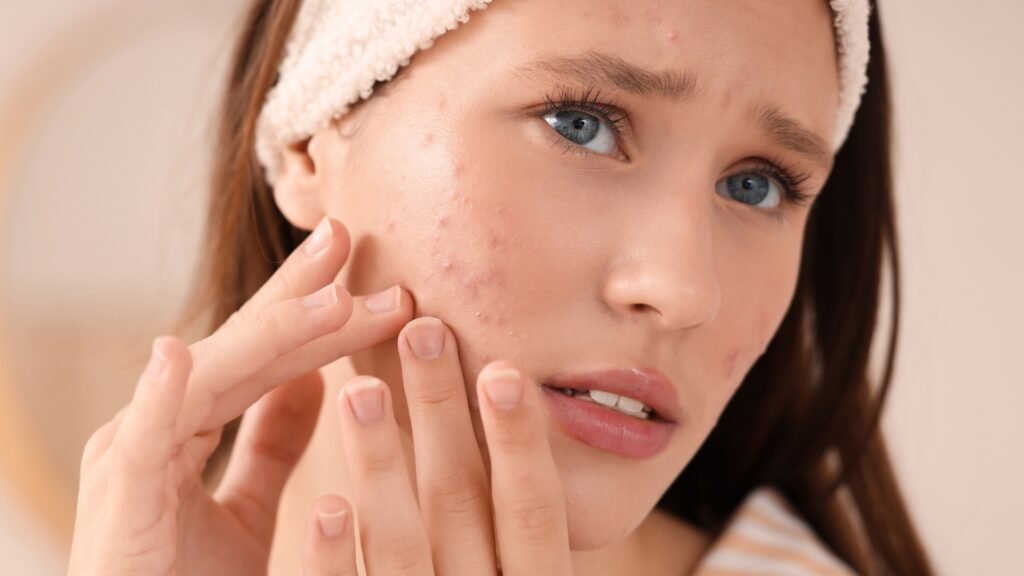 Acne Face Wash