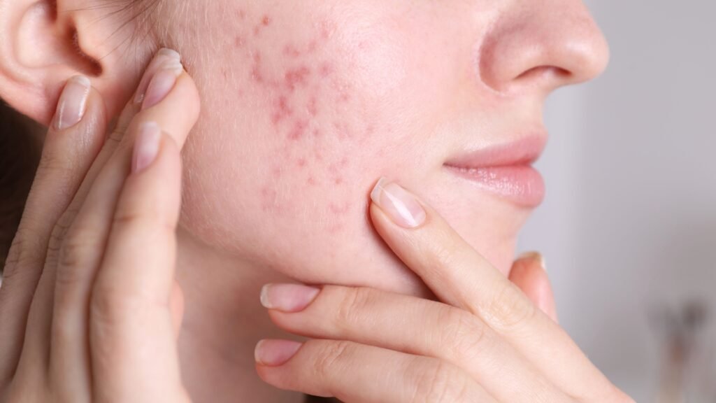 Acne Marks