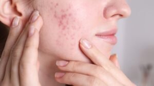 Acne Marks