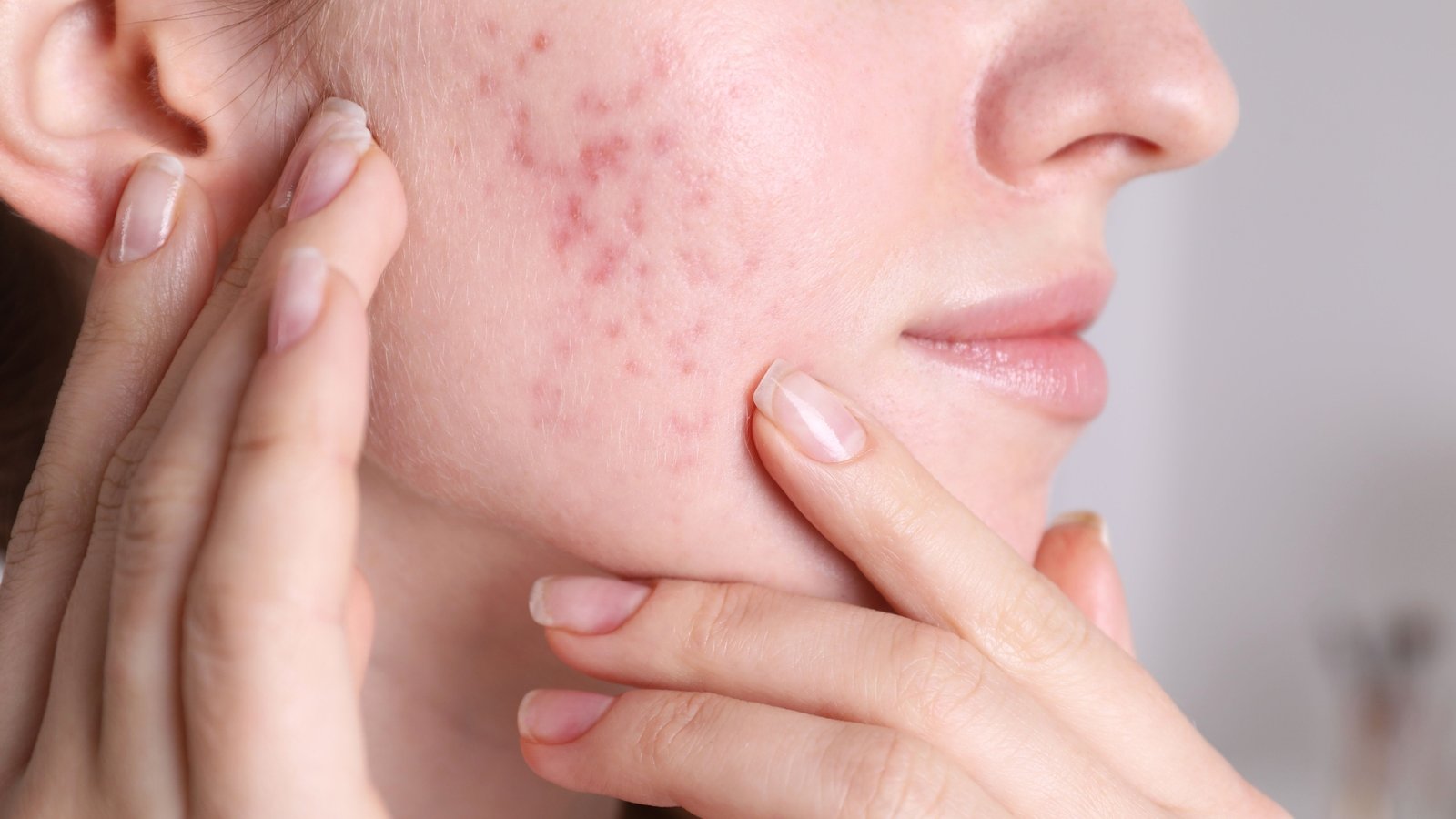 Acne Marks