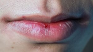 Chapped Lips