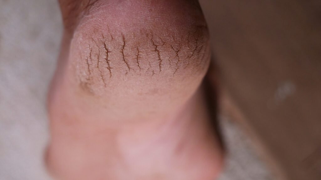 Cracked Heels